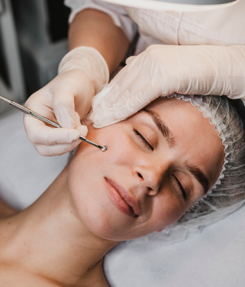 Dermaplaning treatment in Calgary at Homa Skin and Laser