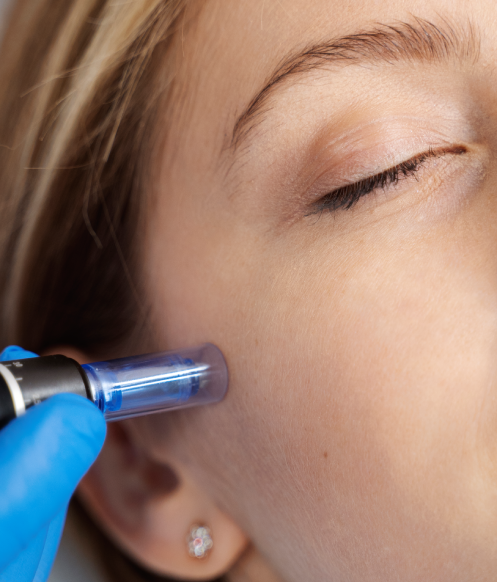 Microneedling treatment in Calgary at Homa Skin and Laser