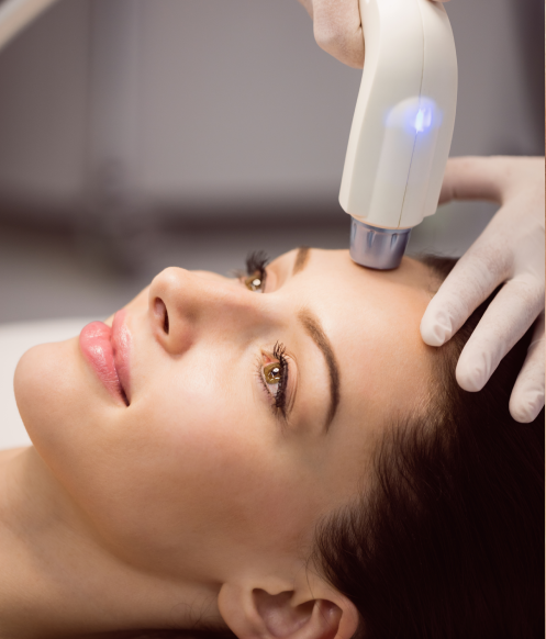 IPL Photo Facial Calgary