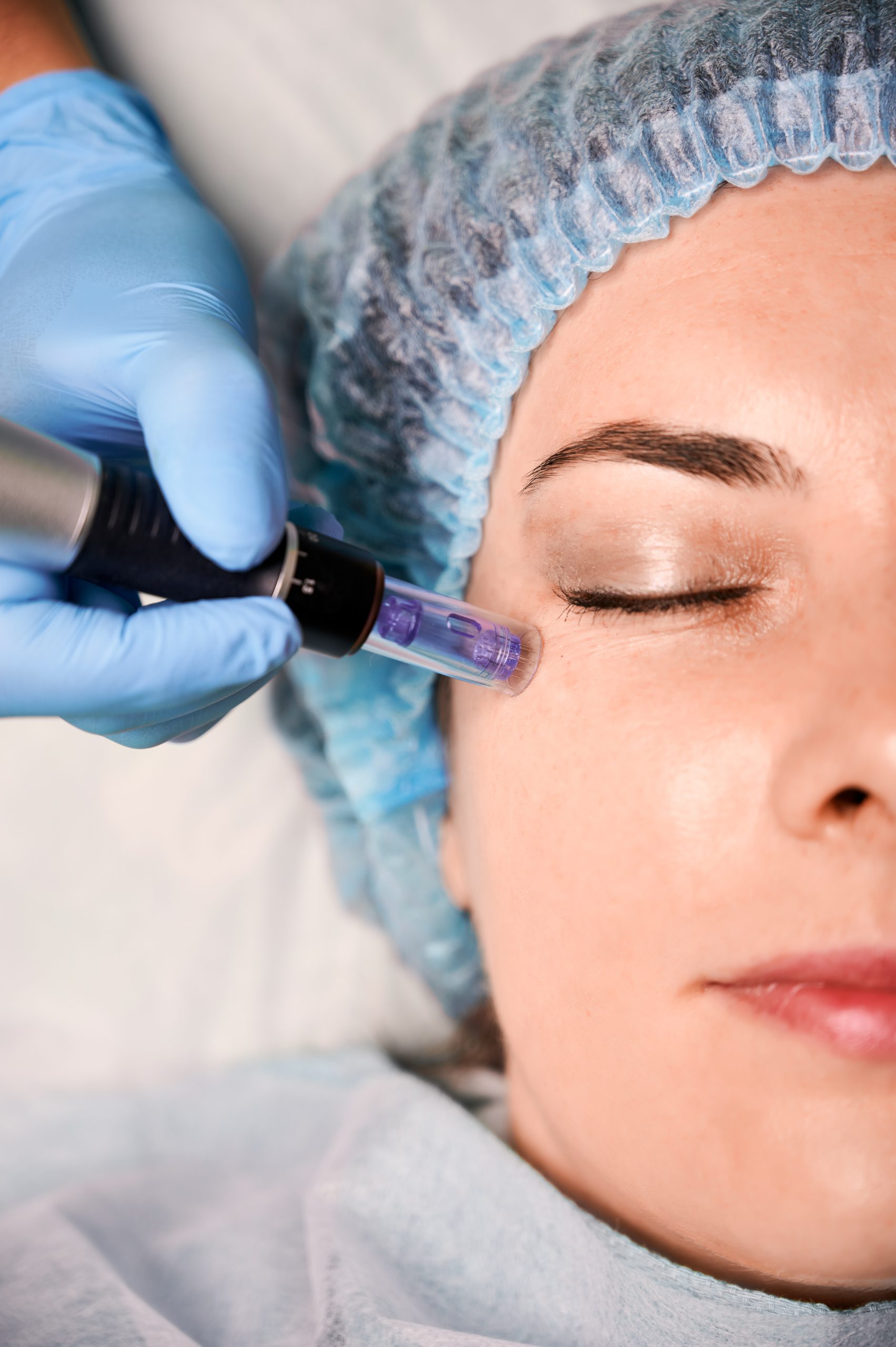 Mesotherapy treatment in Calgary at Homa Skin and Laser