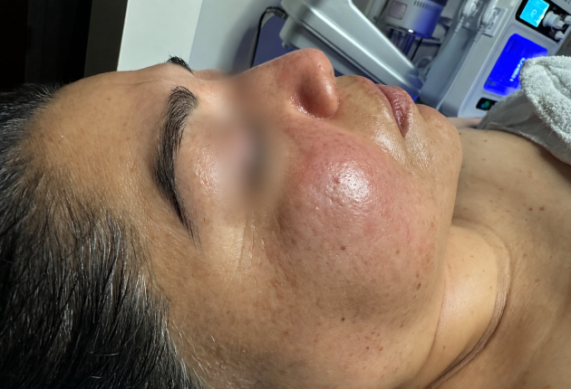 After treatment comparison