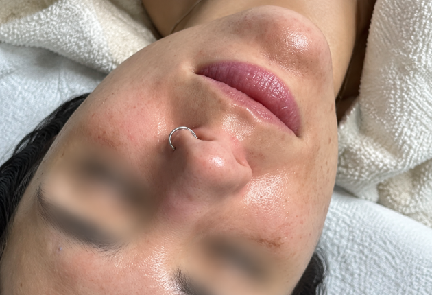 After treatment comparison