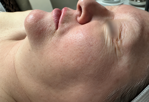 Skin rejuvenation before treatment comparison