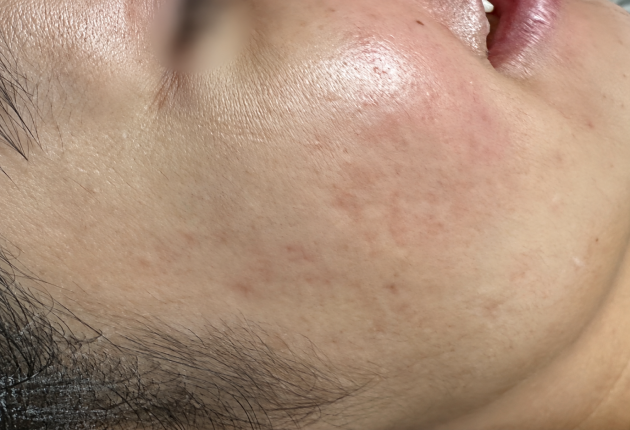 After treatment comparison