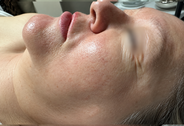 Skin rejuvenation after treatment comparison