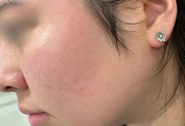 After treatment comparison