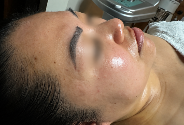After treatment comparison